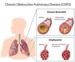 Χρόνια αποφρακτική πνευμονοπάθεια Pneumosleep.gr