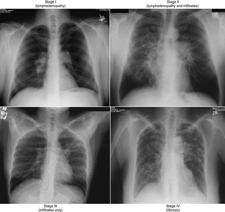 Σαρκοείδωση - Ακτινογραφία - Πρόληψη Pneumosleep.gr
