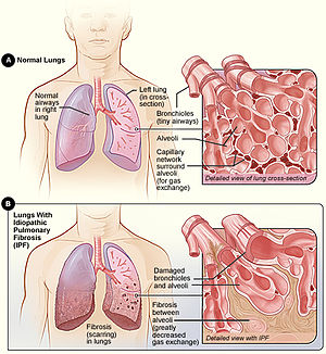 Ιδιοπαθής Πνευμονική ίνωση Pneumosleep.gr